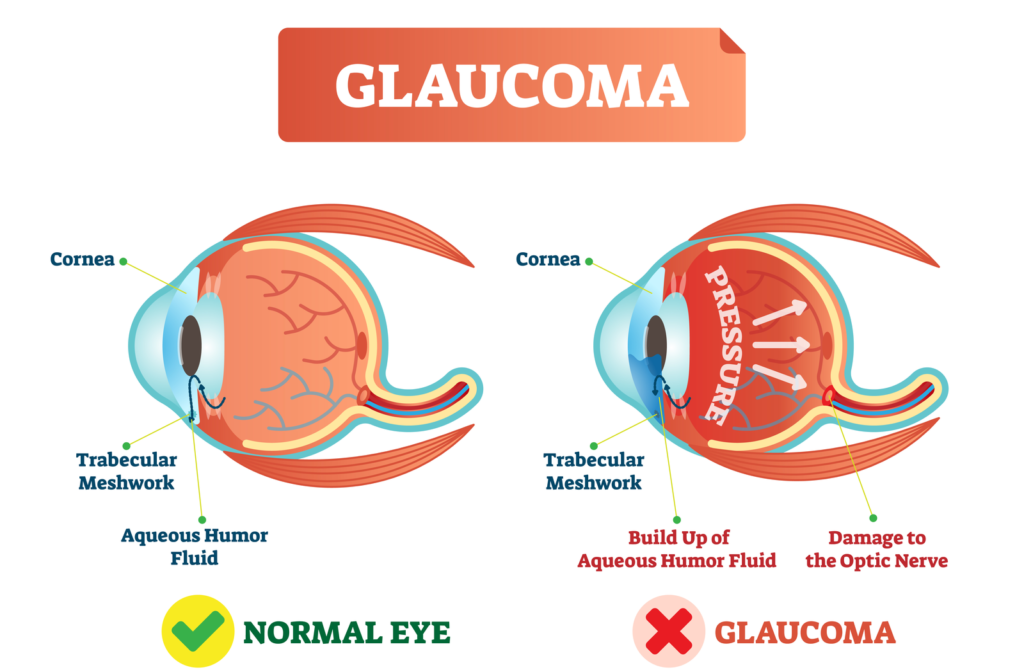 Diagram showing how intraocular pressure damages the optic nerve during glaucoma