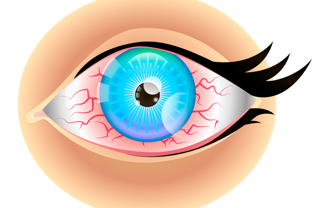 Rendering of dry eye with inflamed red blood vessels