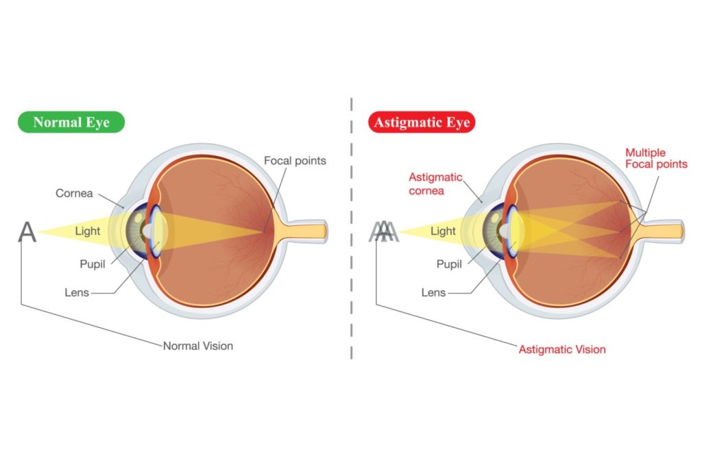 Illustration of normal eye on the left and an eye on the right with astigmatism.